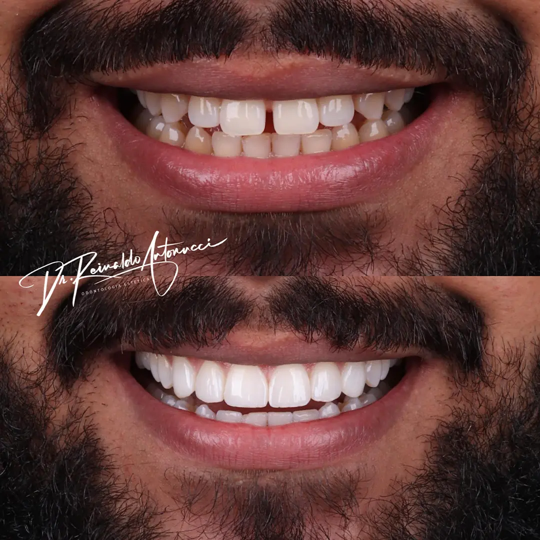 Antes e depois 01 - Dr. Reinaldo Antonucci