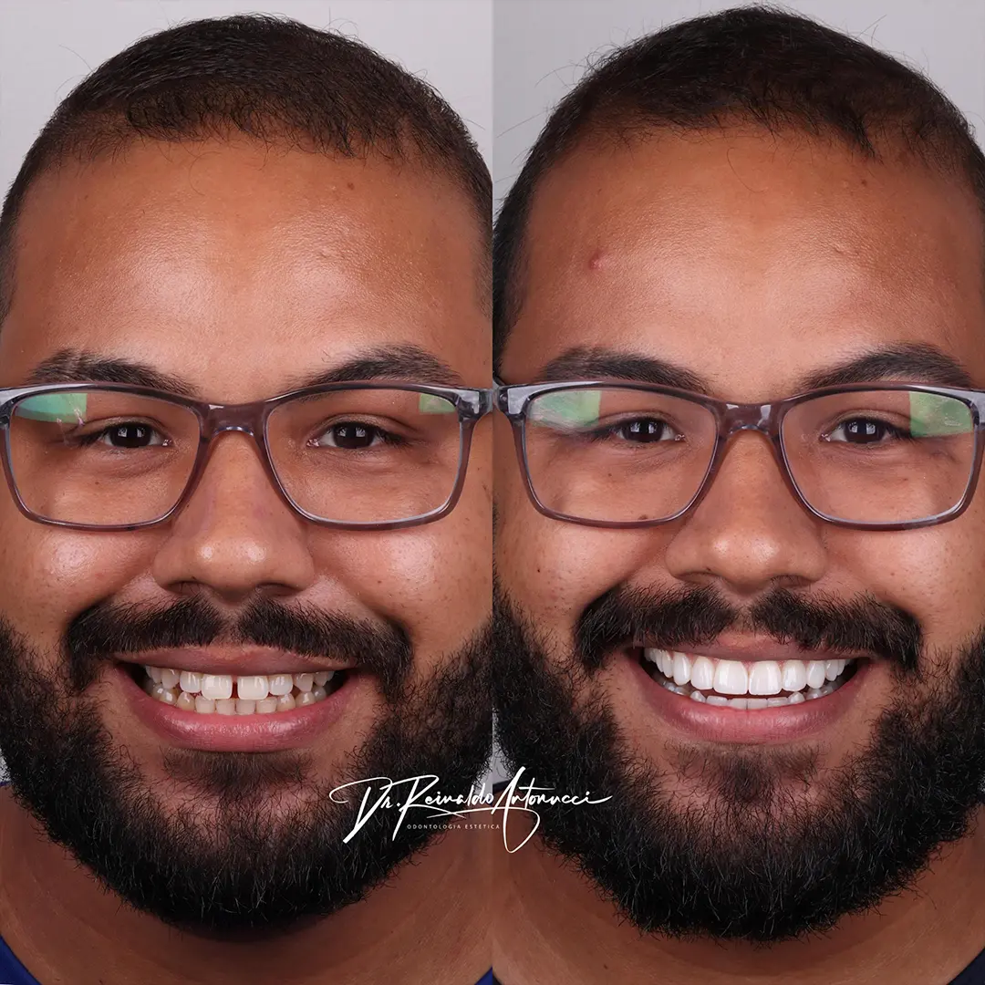 Antes e depois 02 - Dr. Reinaldo Antonucci