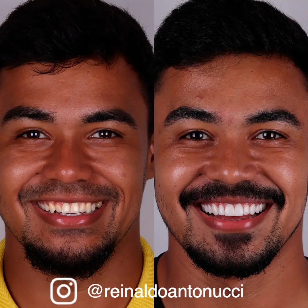 Antes e depois 03 - Dr. Reinaldo Antonucci