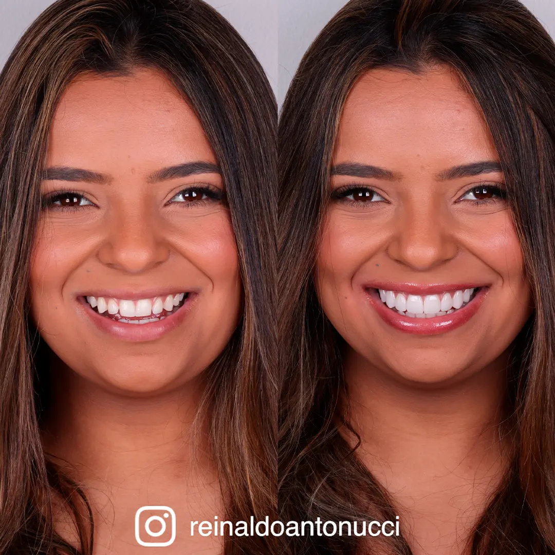 Antes e depois 04 - Dr. Reinaldo Antonucci